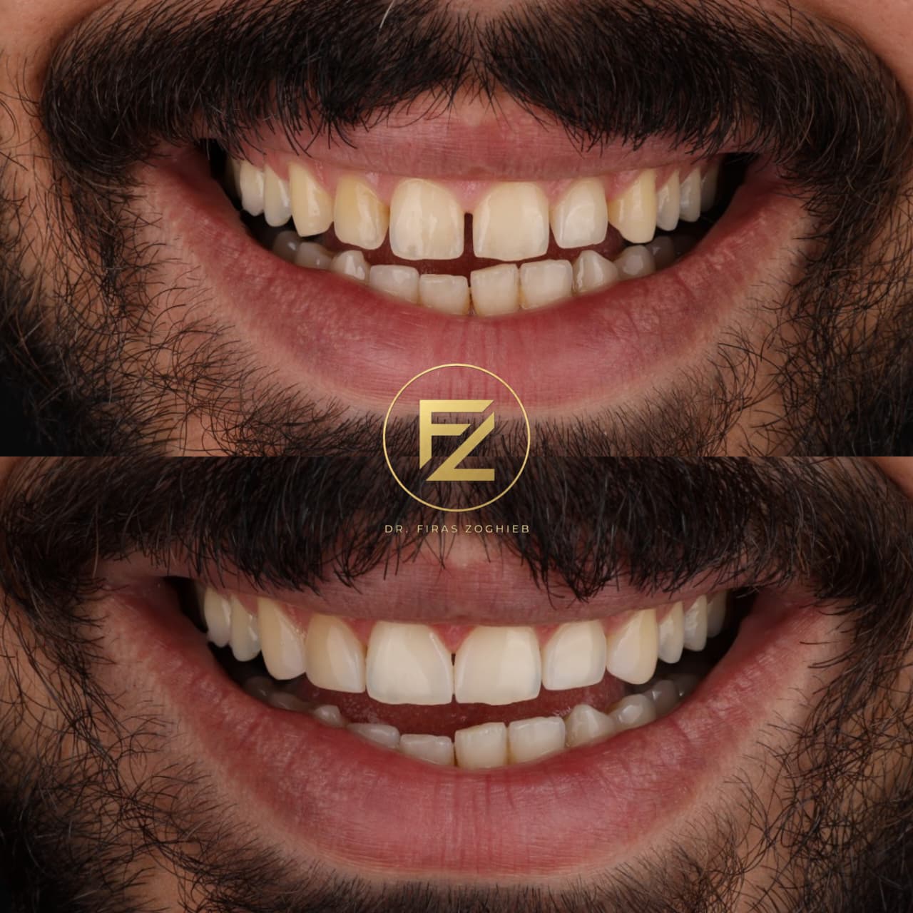 Gapped Teeth