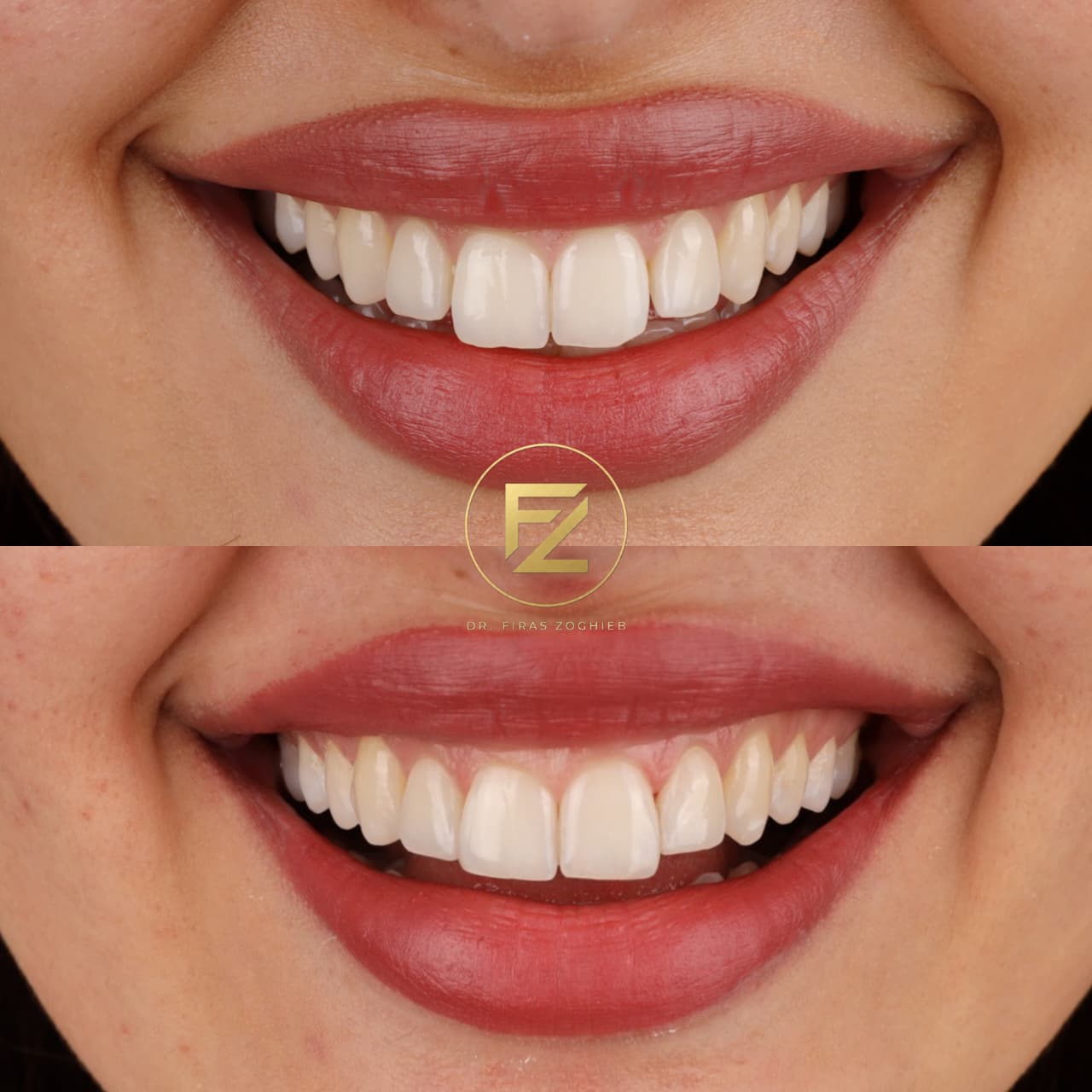 Composite Edge Bonding