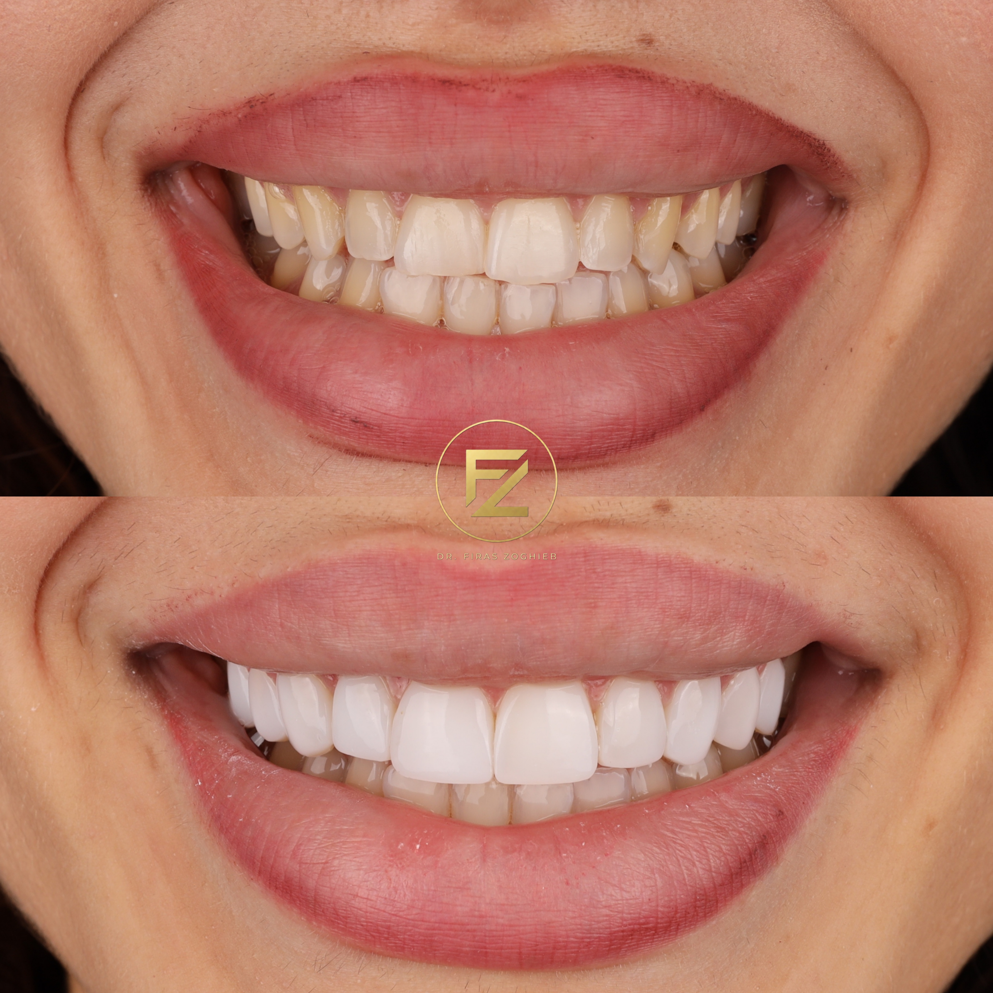 Stained Teeth