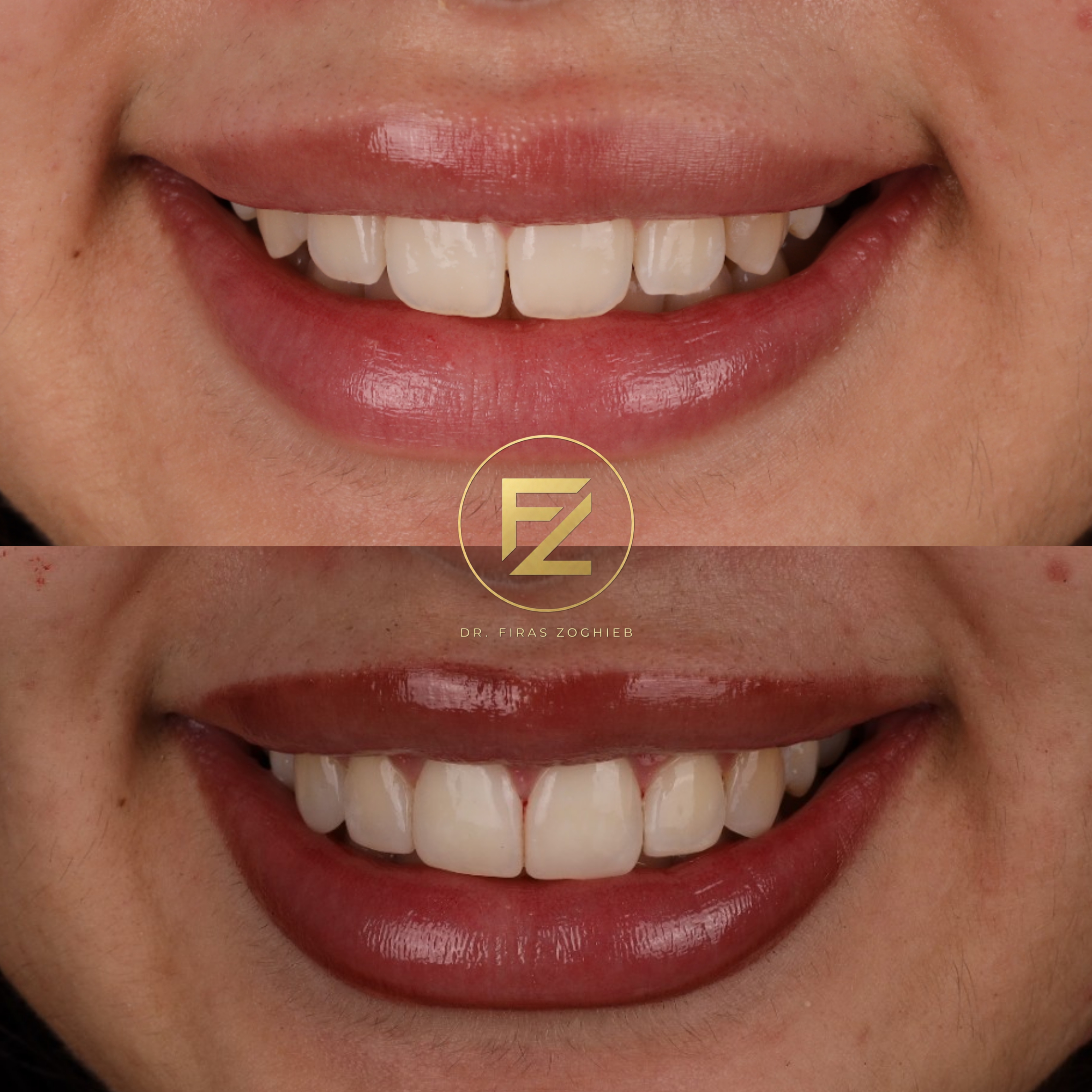 Stained Teeth