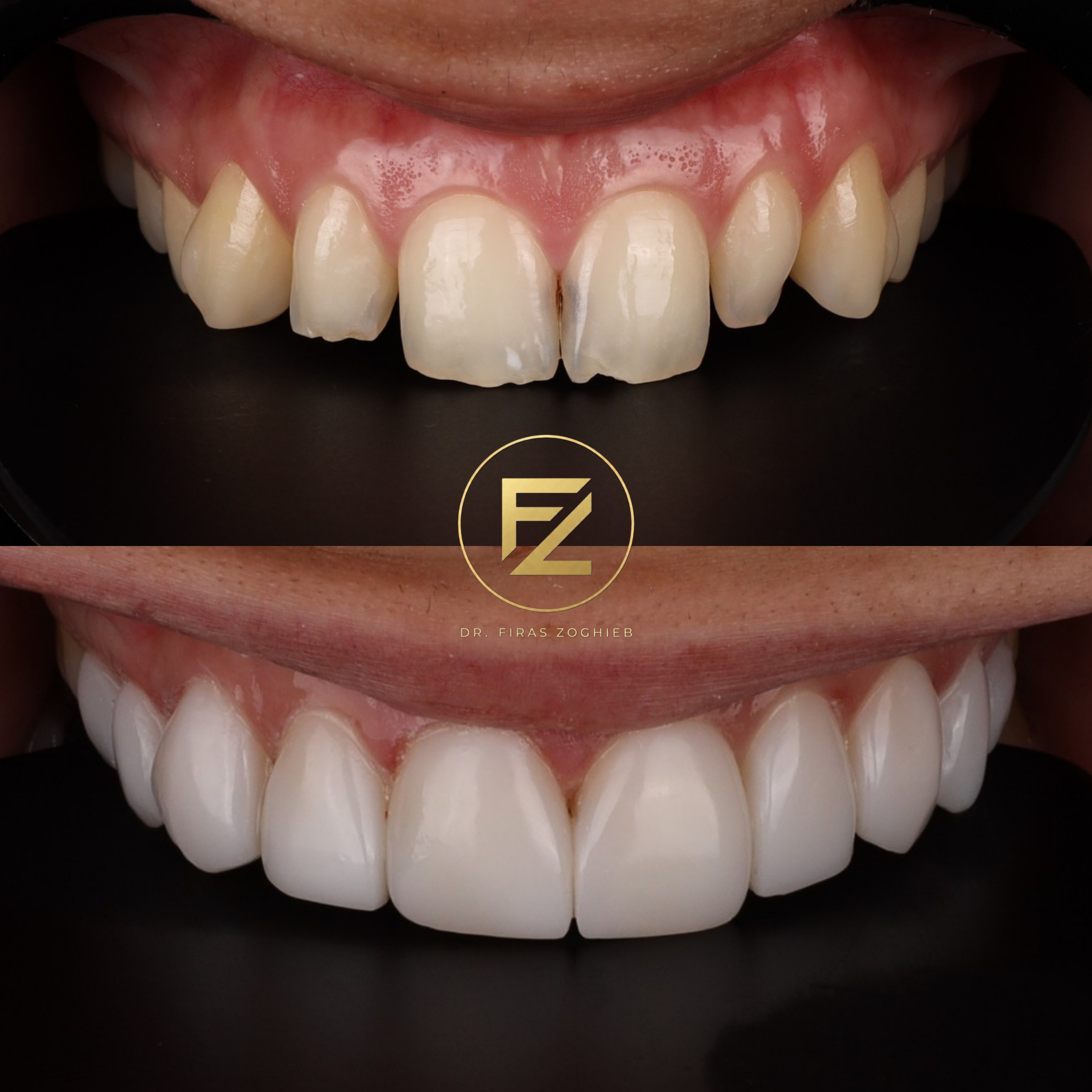 Front Teeth Enhancement