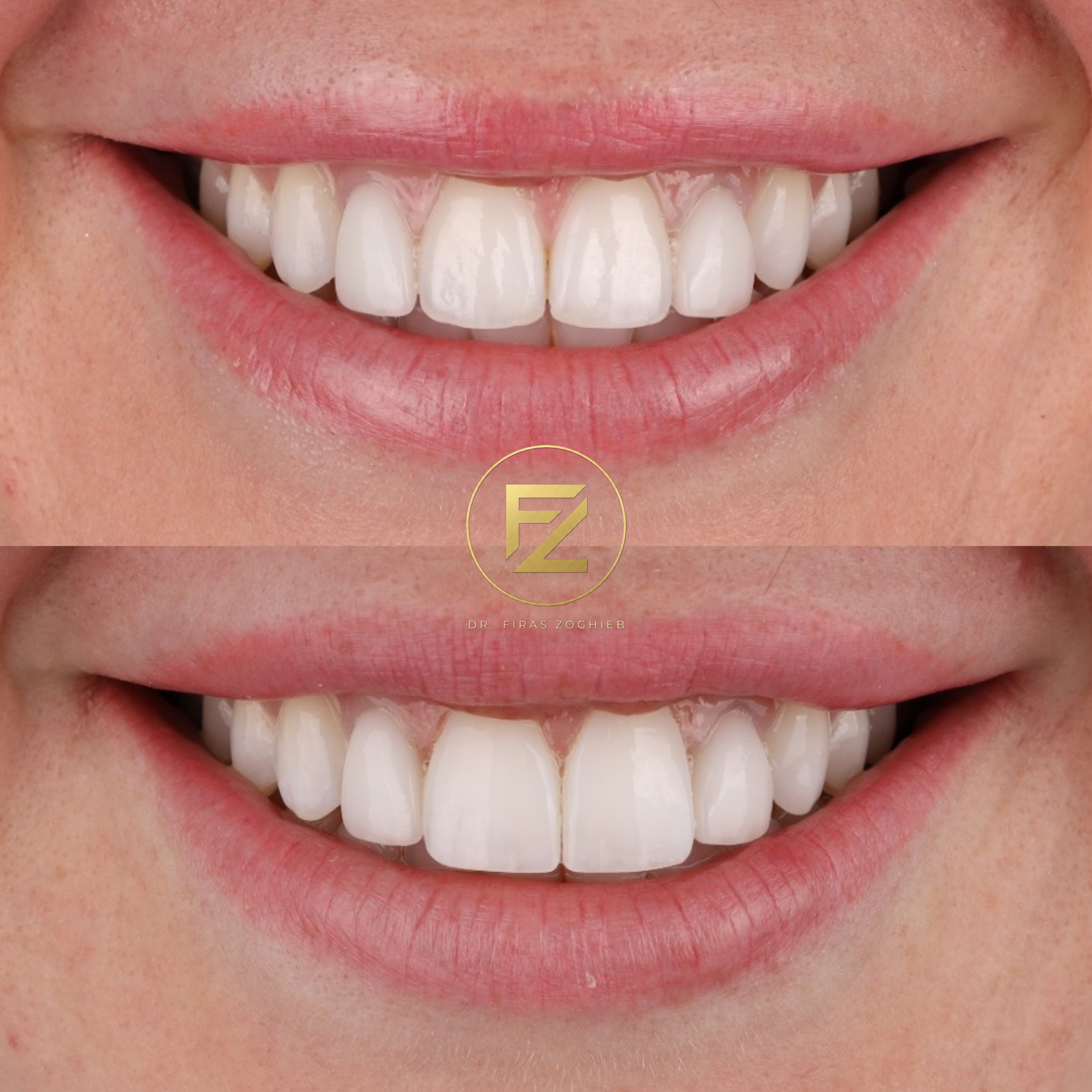 Front Teeth Enhancement