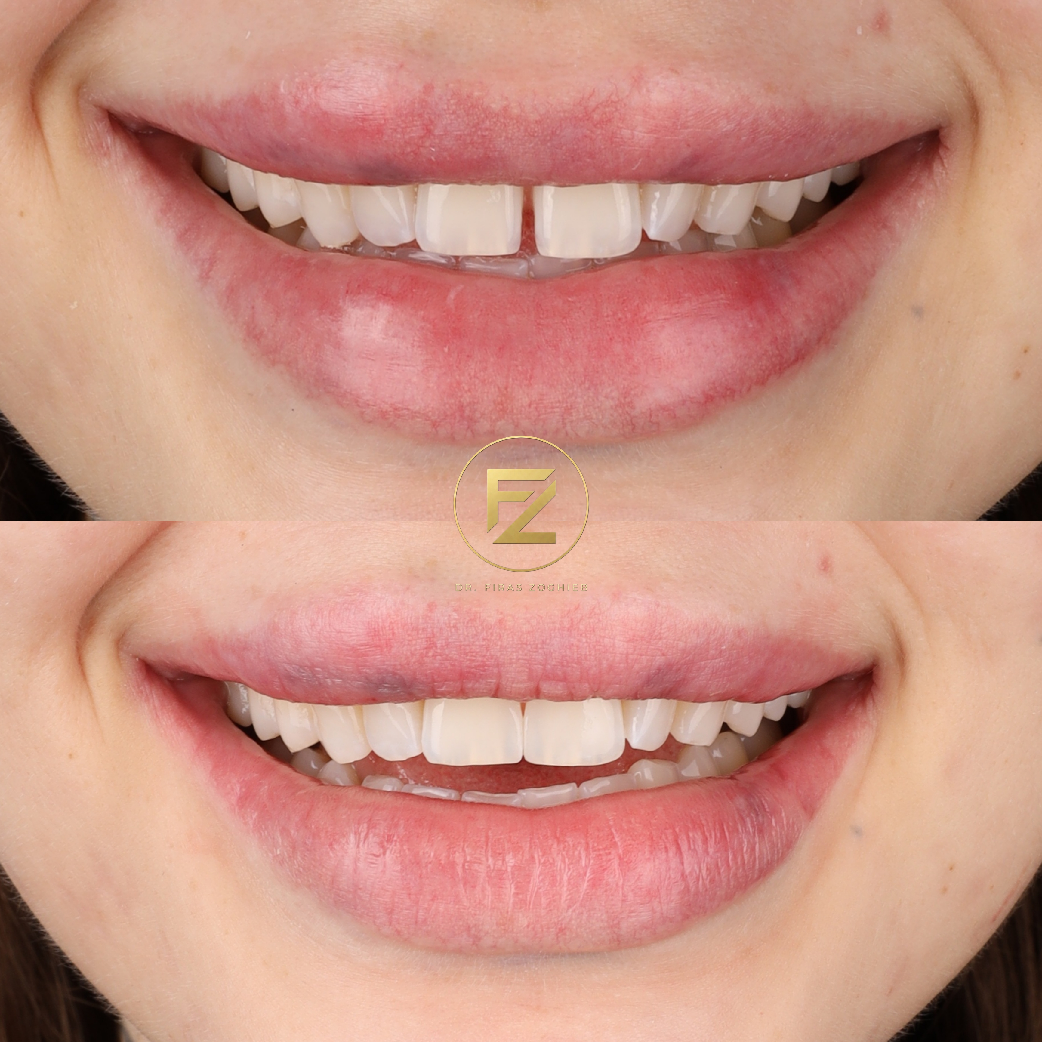 Gapped Teeth