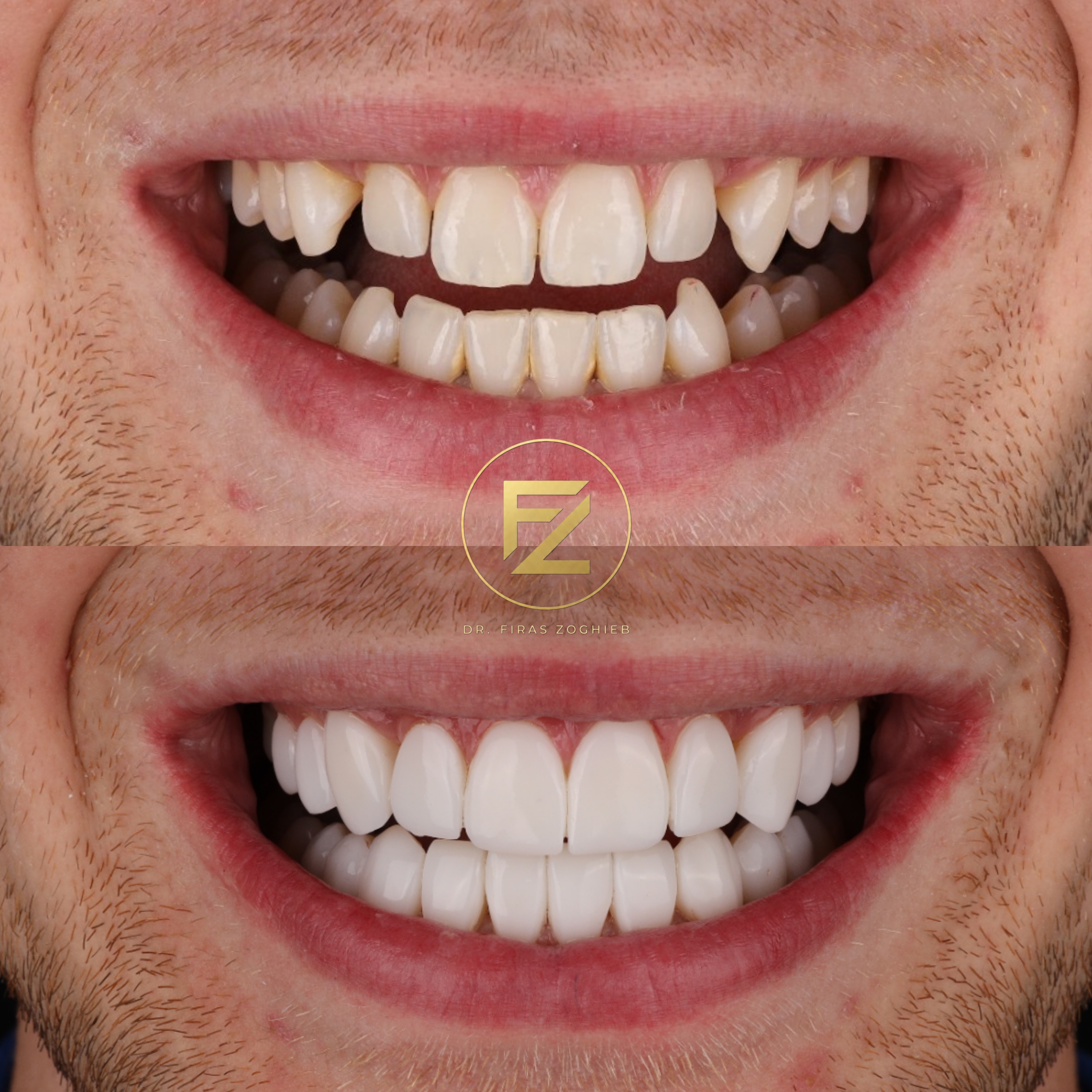 Gapped Teeth