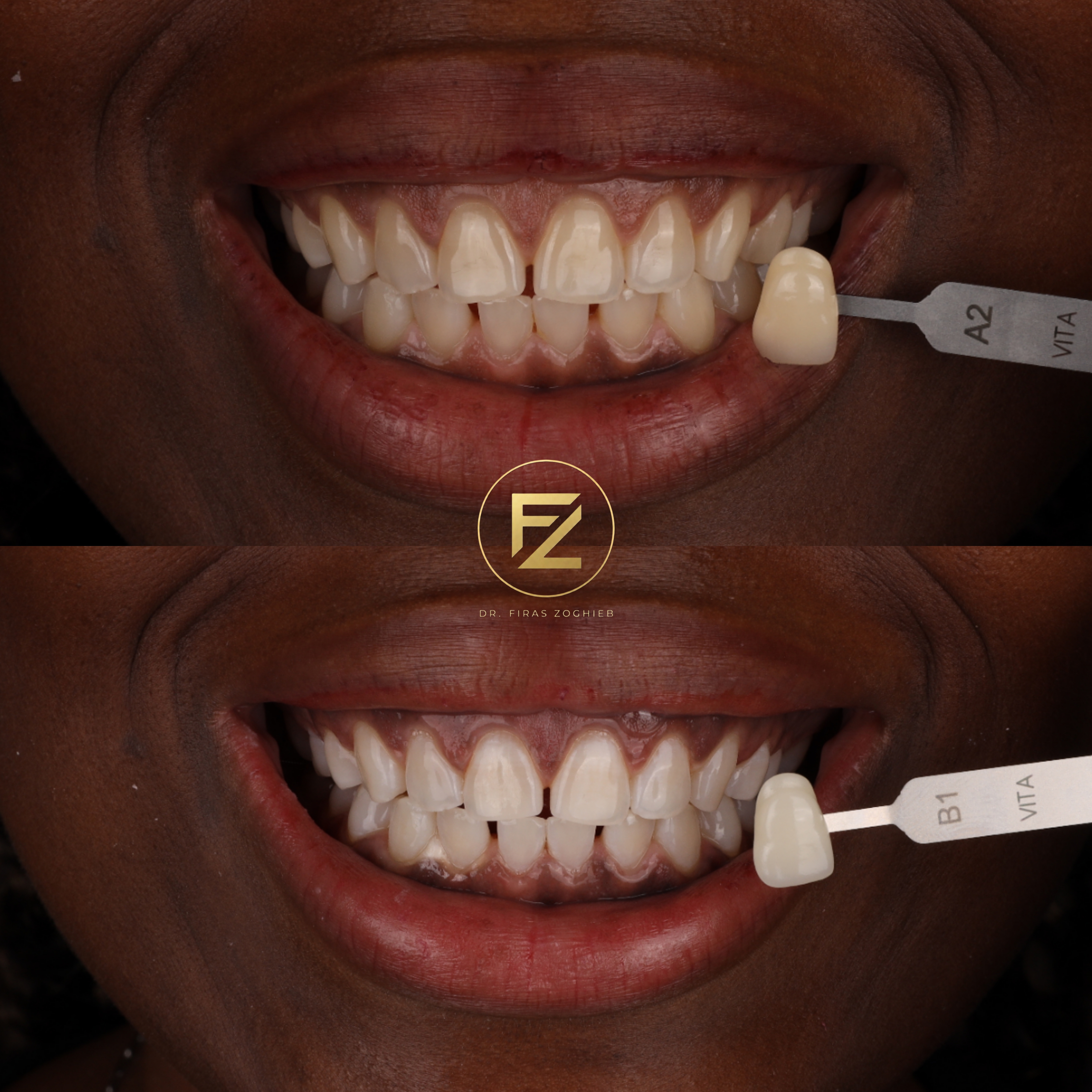 Teeth Whitening