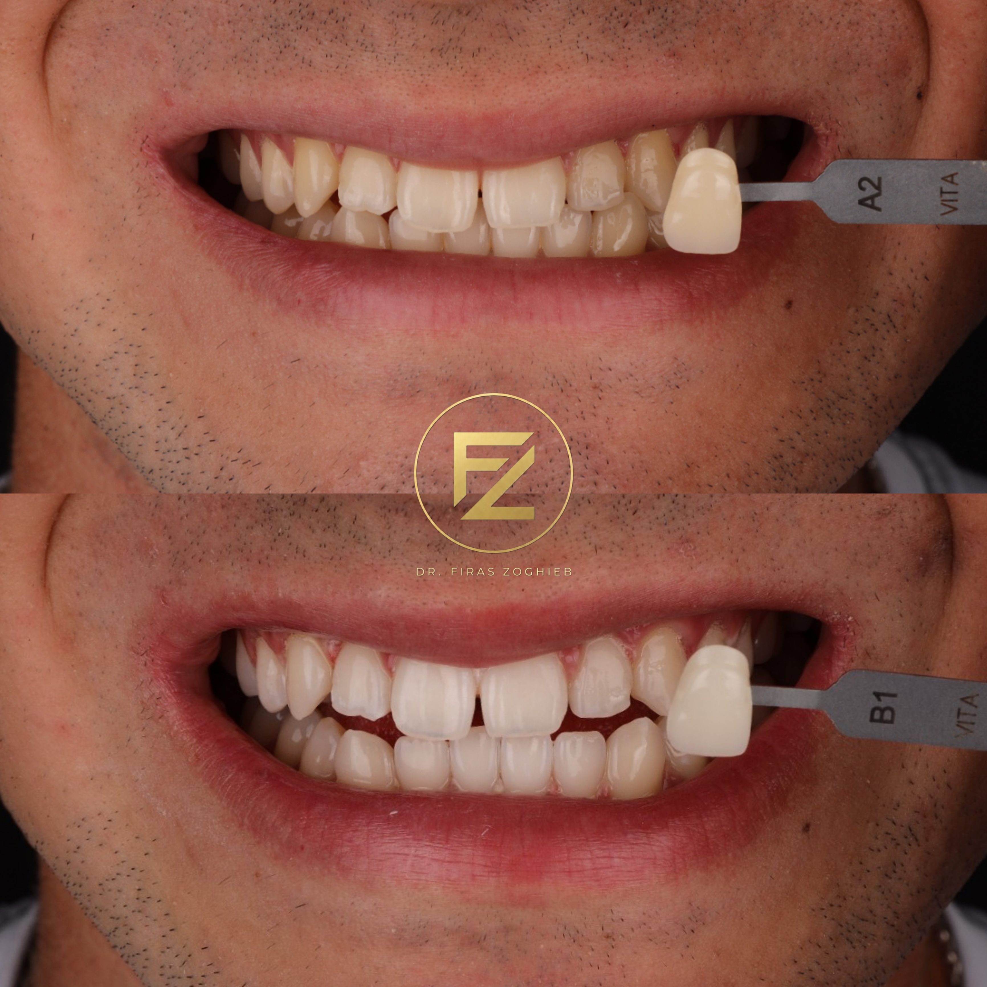 How Long Does Teeth Whitening Last in Dubai? What Patients Should Know