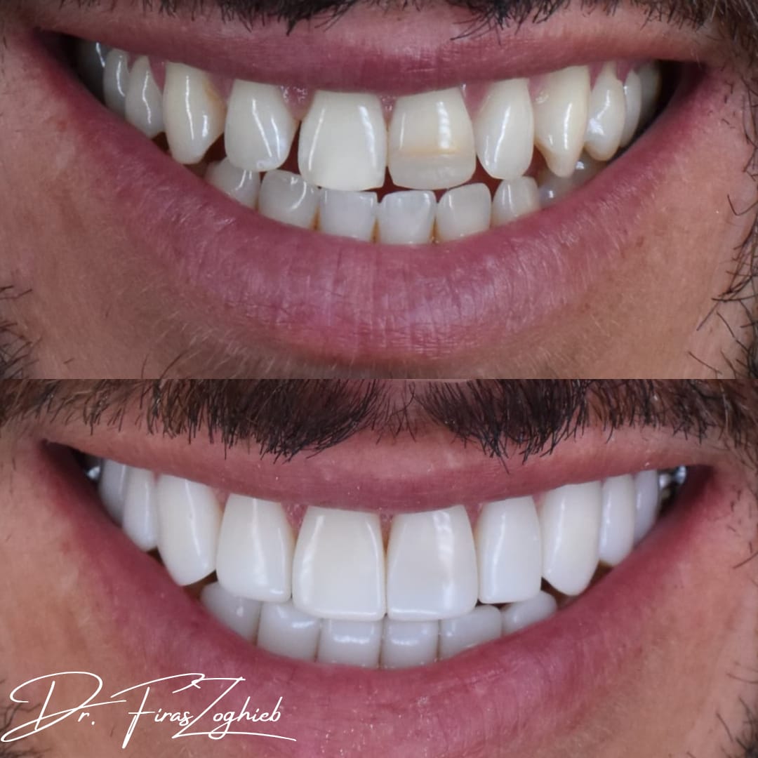 Before & After - composite bonding