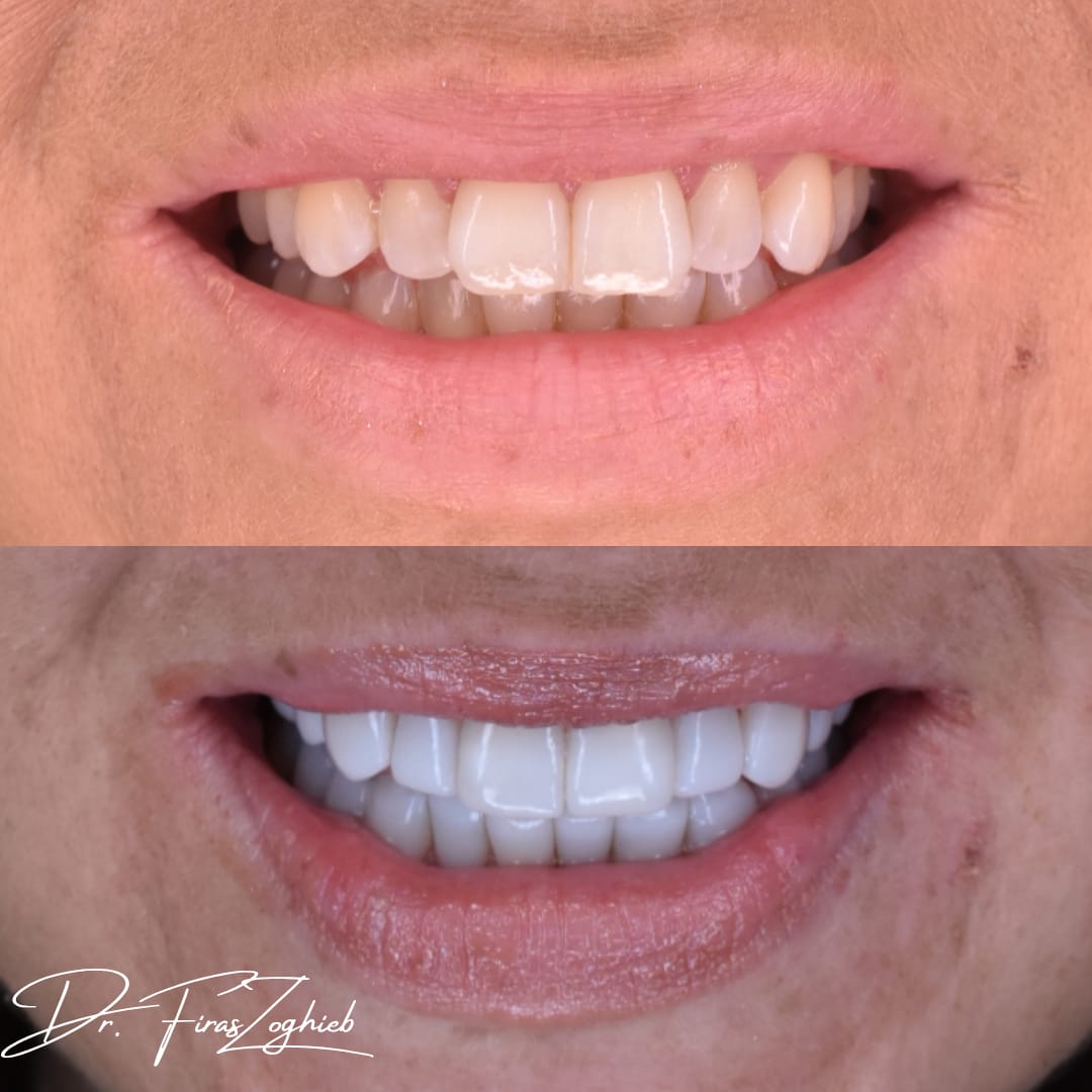 Before & After - Composite Bonding