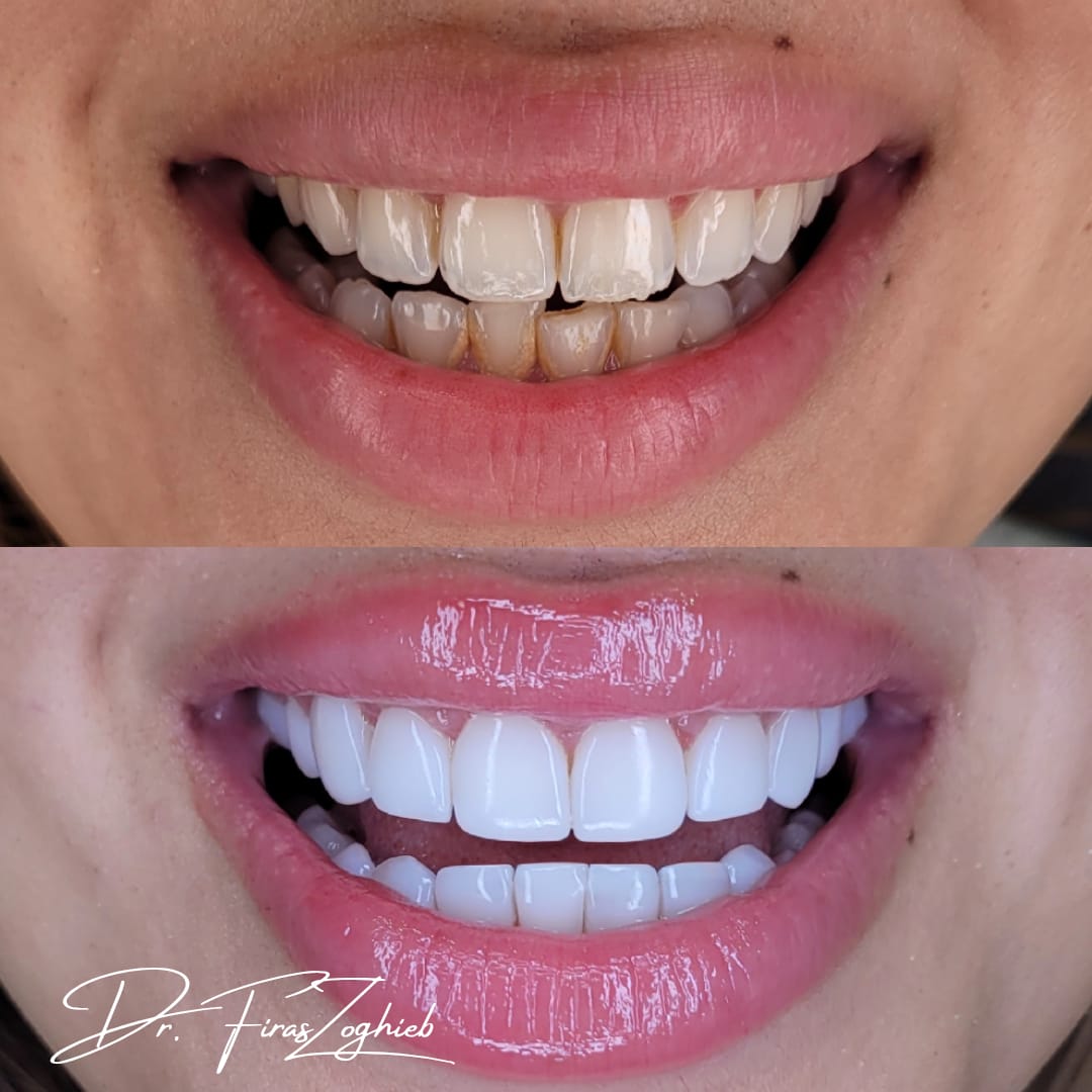 Before & After - Composite Bonding