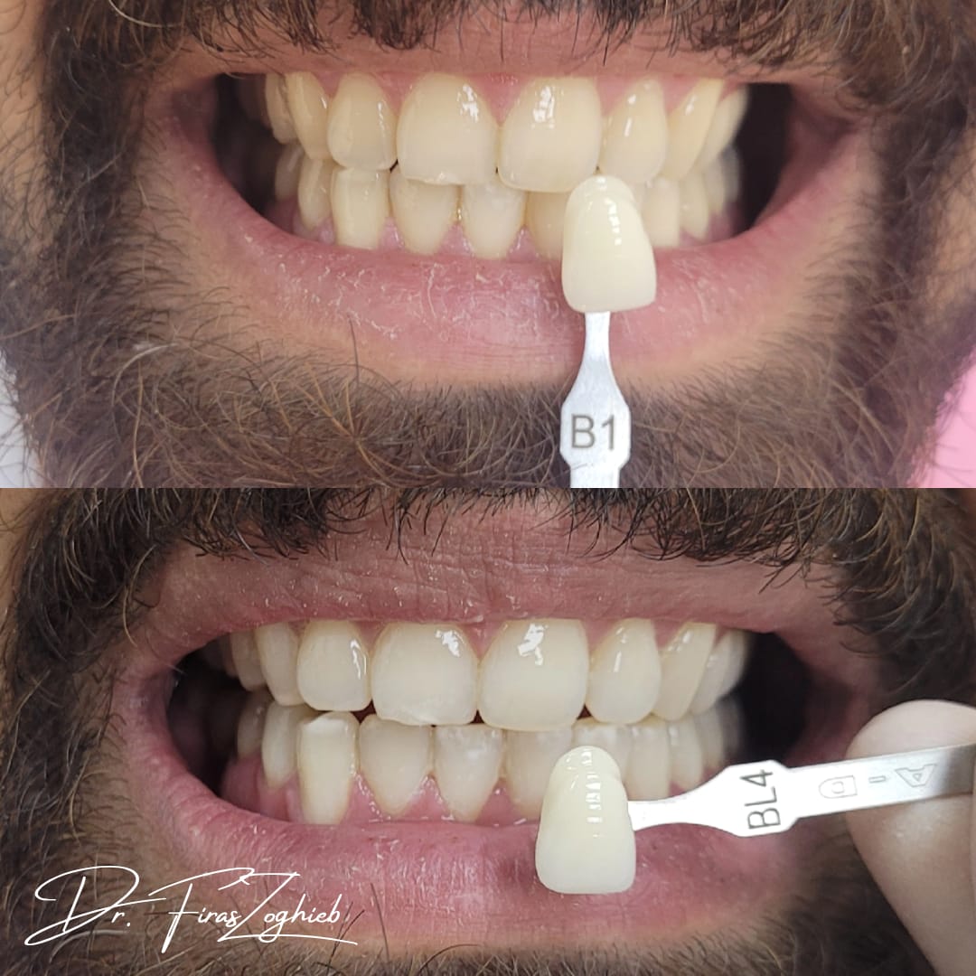Teeth Whitening