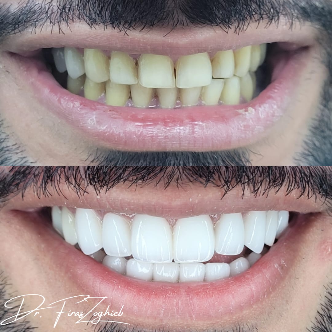 Porcelain veneers