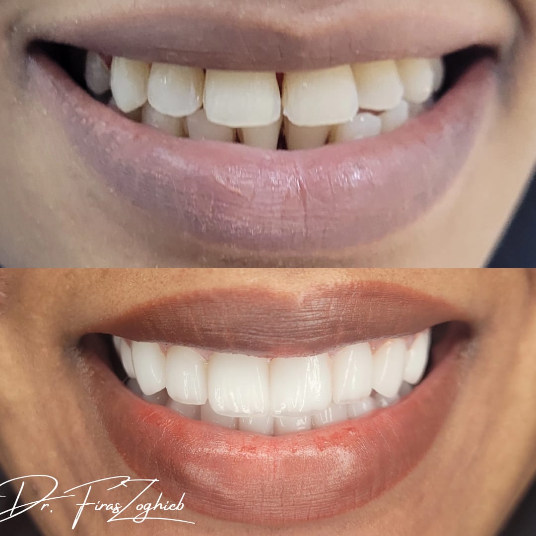 Porcelain veneers