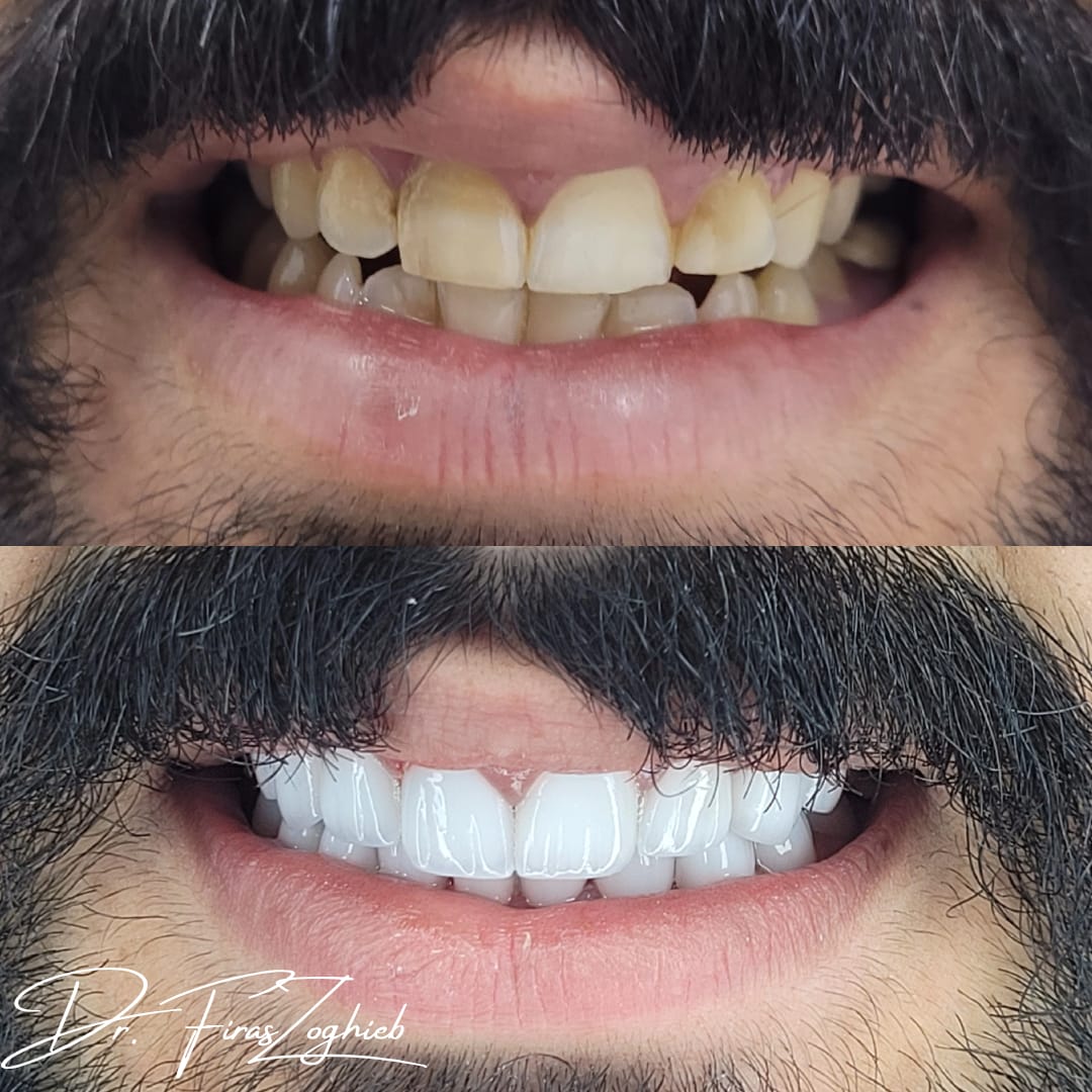 Porcelain veneers