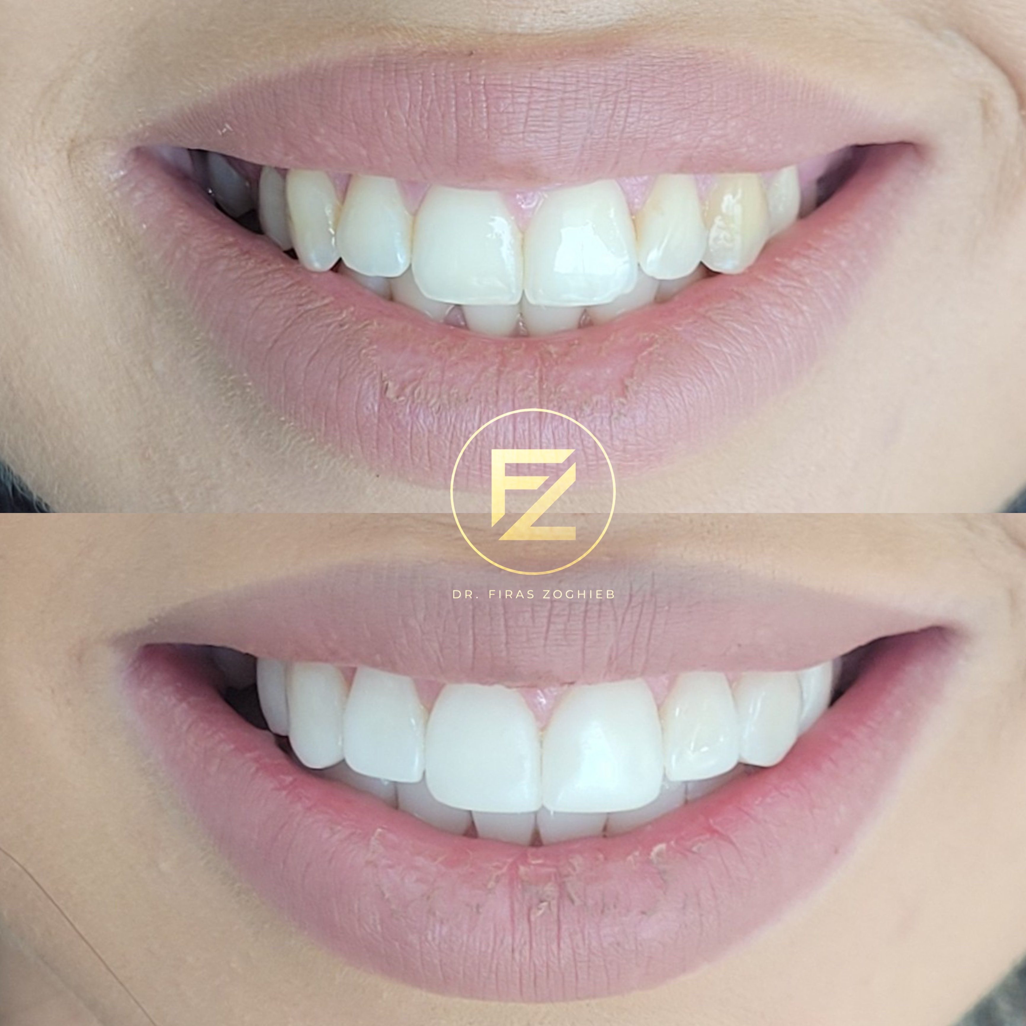 Front Teeth Enhancement