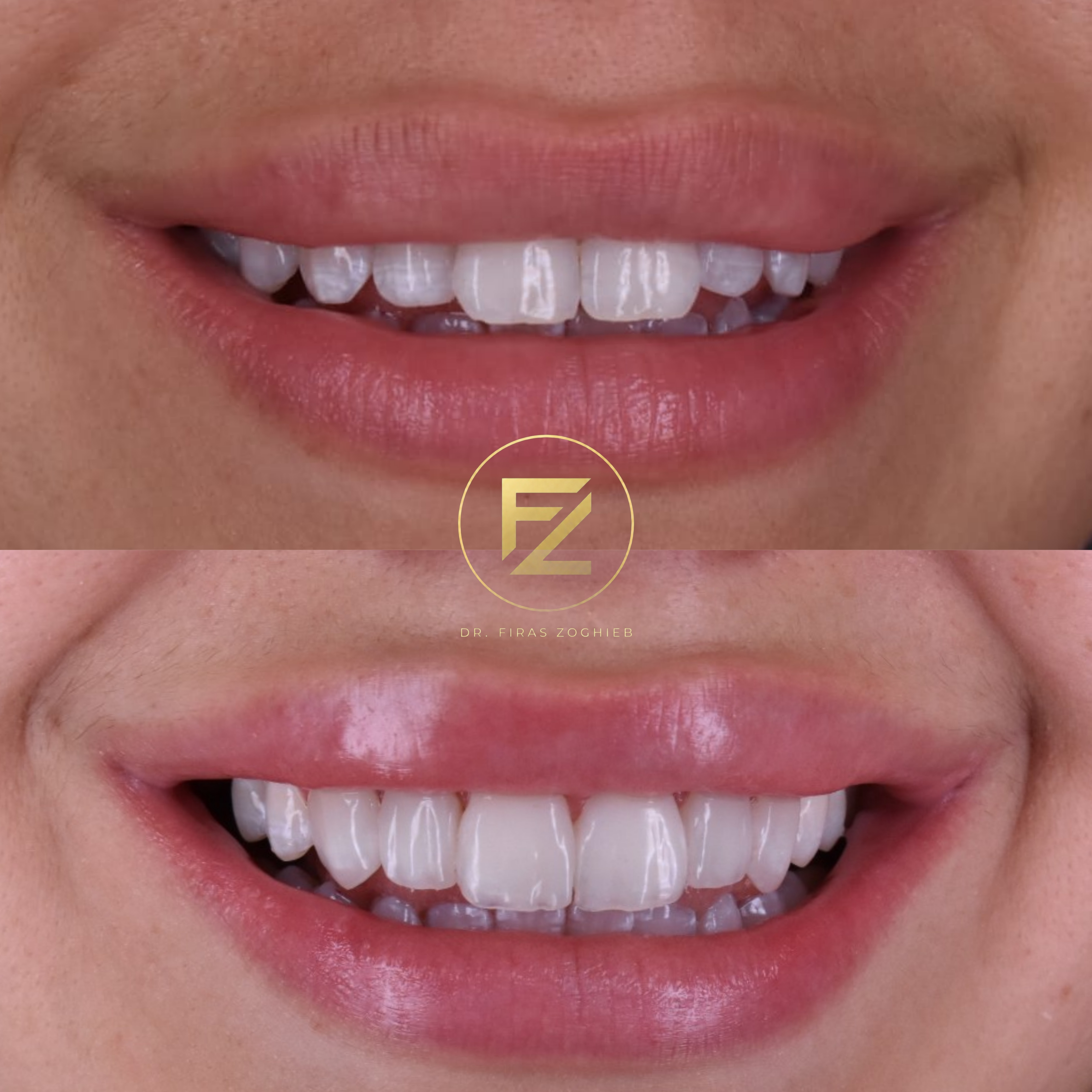 Front Teeth Enhancement
