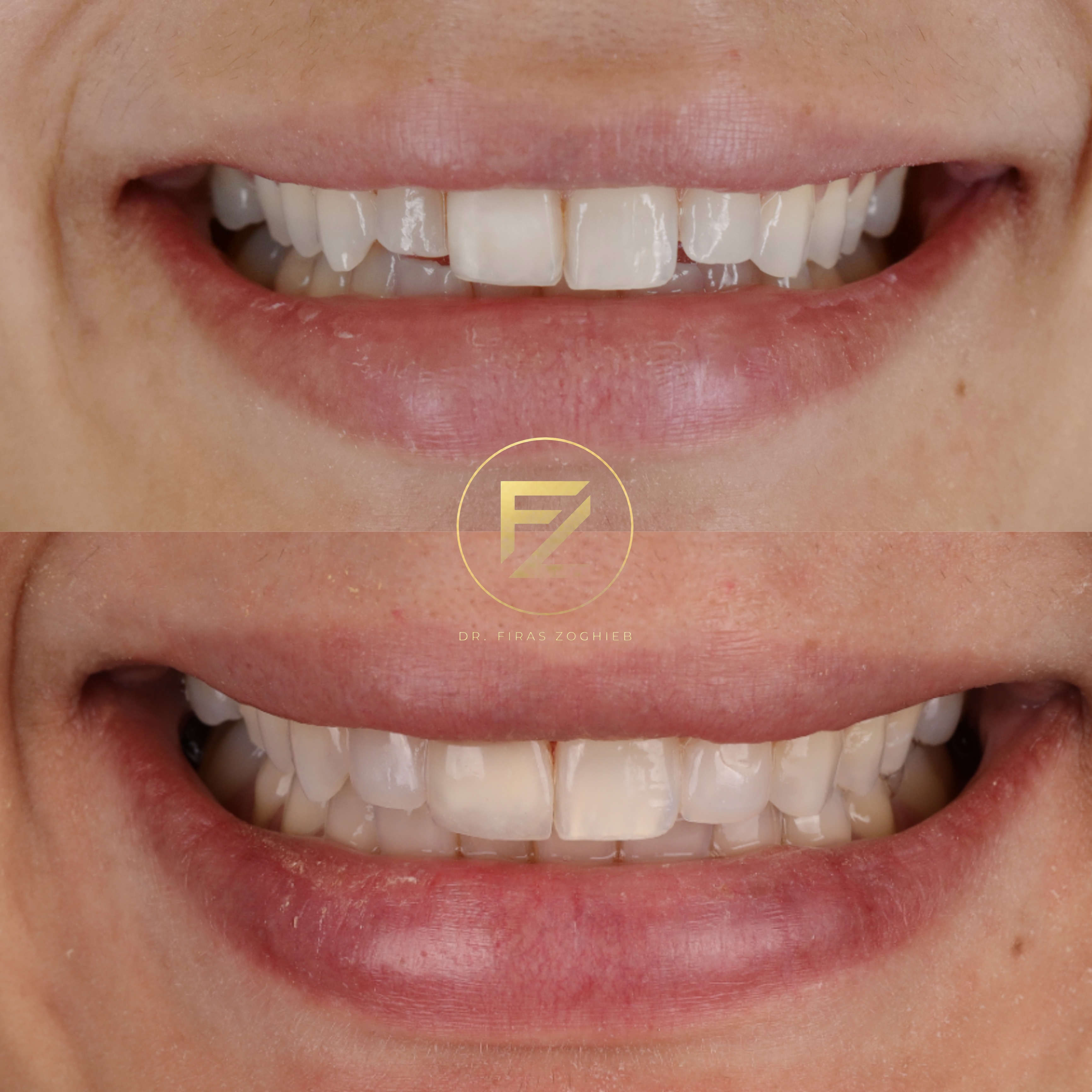 Front Teeth Enhancement