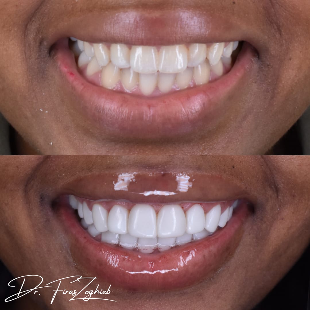 Misaligned Teeth