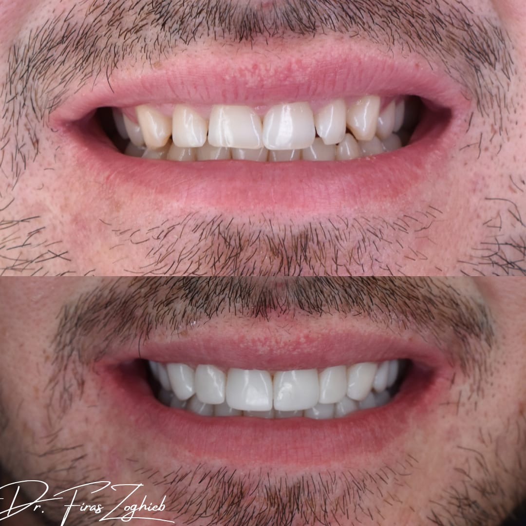 Small Teeth