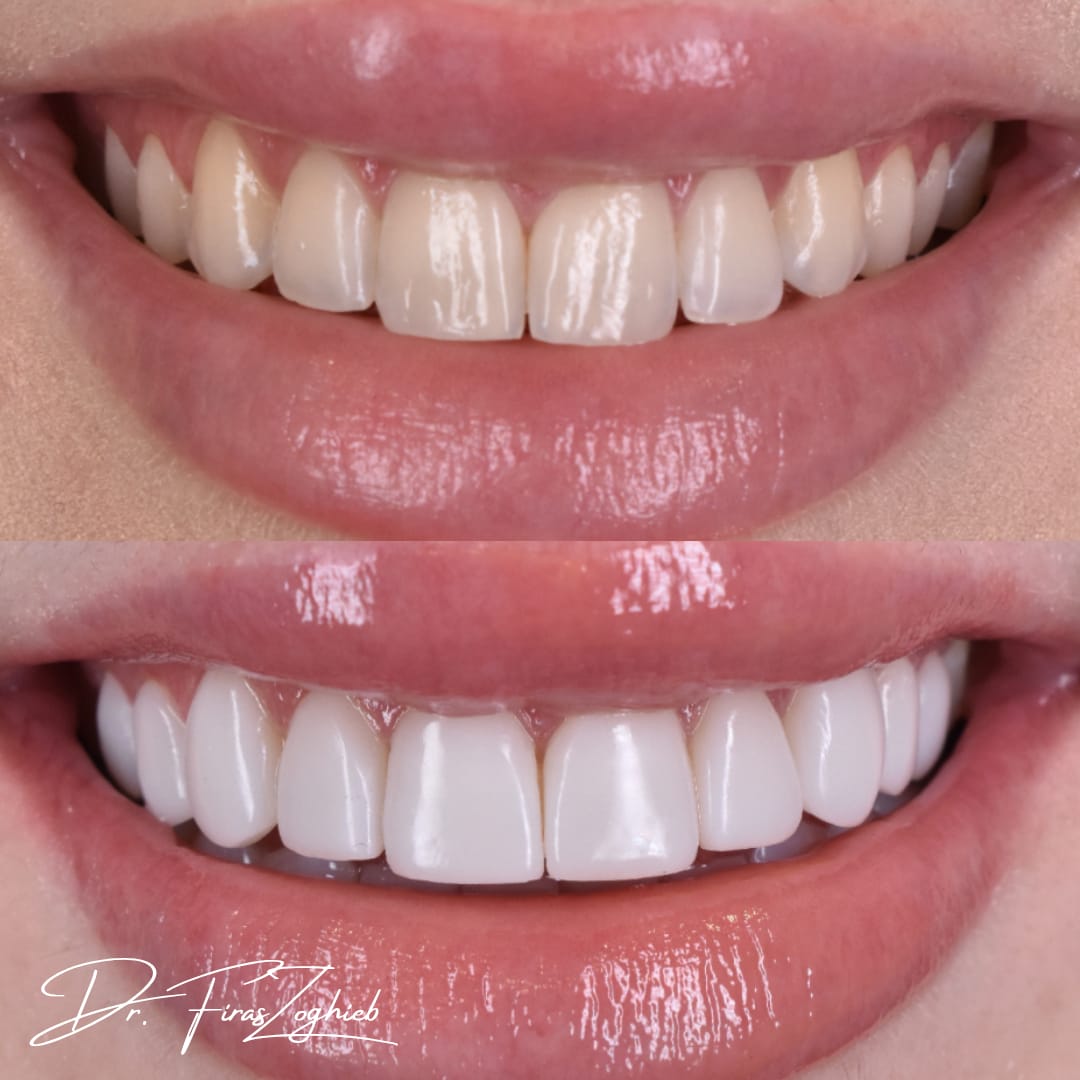 Stained Teeth