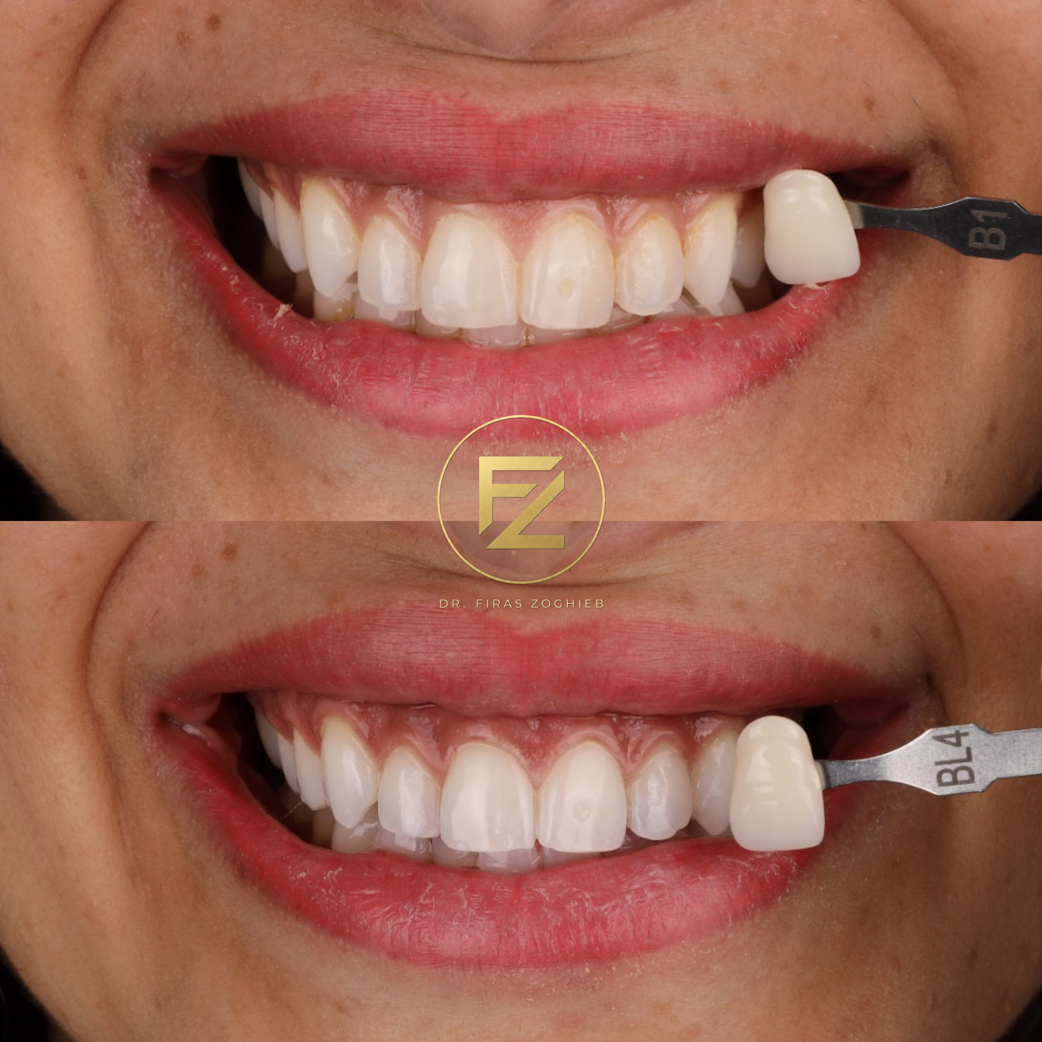 Teeth Whitening